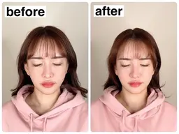 【新人スタッフクーポン】【エラ張り改善】エラ張り集中小顔コース ¥12,000→¥1,000
