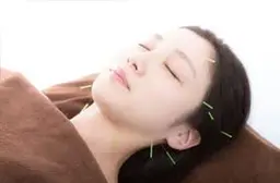 美容鍼灸【ご新規様期間限定✨】8900→2500