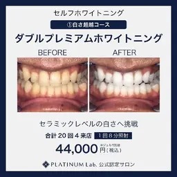 【ダブルプレミアムセルフホワイトニング】※ジェル代別途※