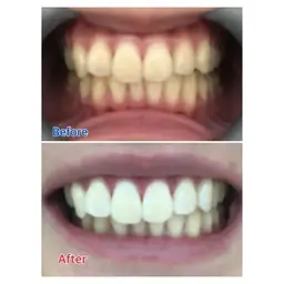 ☆minimo限定☆学割！ホワイトニング体験ロングコース🦷！