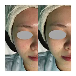 【ツルスベお肌へ✨】光フェイシャル
