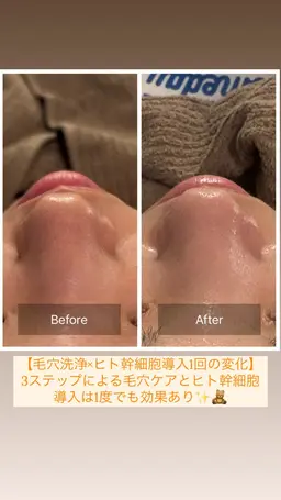 【毛穴特化】 3STEP毛穴洗浄✕45％ヒト幹細胞導入✕肌質別パック70分