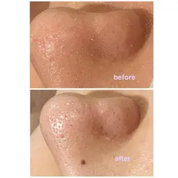 【小鼻の黒ずみやゴワつきが気になる人】毛穴洗浄ハイドラフェイシャル【2回目まで同価格】