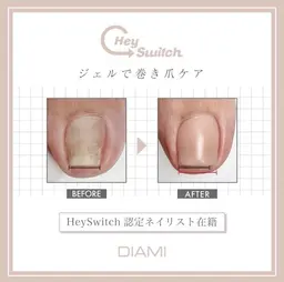 ジェルで巻き爪ケア