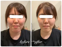 【即効性&持続力】即効小顔/乾燥くすみ 小顔専用機器フェイシャル