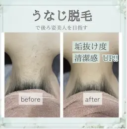 きらきらミニモ成人式前うなじ脱毛🐻脱毛未経験の方のみ対象🐻💕着物を着るなら襟足の脱毛は必須です✨