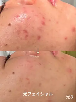 光フェイシャル|赤み・ニキビ跡・くすみ