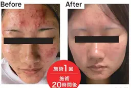 《韓国風ちゅるん肌》幹細胞ポレーション導入♡毛穴・ニキビ・乾燥・赤み...全部まるっとケアできる贅沢トリートメント♡