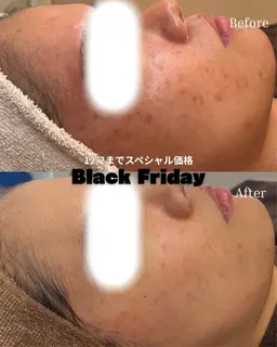 【ブラックフライデー限定】剥離なしハーブピーリング￥8500