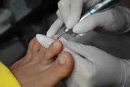 【足の専門家】肥厚爪・変形爪ケアコース40​〜​90分¥4400​〜​¥9900(お爪の状態に料金は変動)【初診料別途550円】