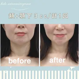 【60分】韓国発レモン🍋小顔フェイシャル🍋3ccボトル【頬+顎下】