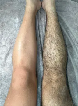 🌟男性🌟【魅せる脚.腕】両足両腕ブラジリアンワックス脱毛