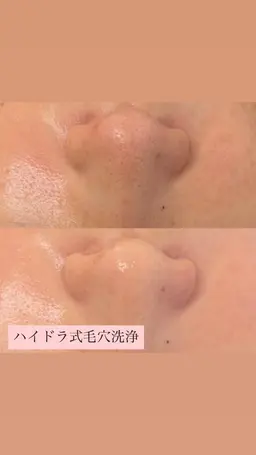 【毛穴の詰まり•黒ずみ•開き】に✨痛みがなくトルネード🌪️方式の毛穴洗浄でツルツル素肌へ🩵スチーム•パック付き🌈