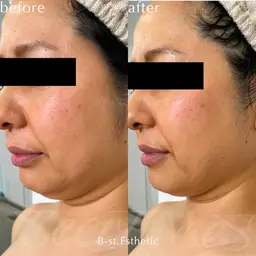 【頭皮】セルフスカルプケア30分間💆🏼‍♀️突起型ヘッドで頭皮に刺激⚡首肩コリ・眼精疲労の回復に効果的⭕️