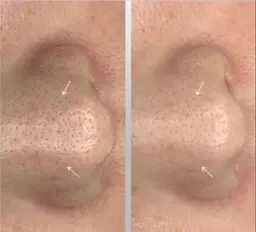 《初回限定》韓国発!SJ究極の毛穴ケアトリートメント+小顔ケア うる艶水光肌 100分