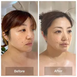 【小顔・たるみケア 1カ月集中プログラム】60分×3回