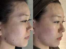 プラズマ光フェイシャル