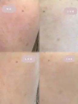 赤ちゃん肌を目指す!シミケア🌿ハーブピーリング+アフターフォロー付