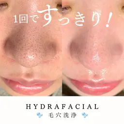 🫧HYDRAFACIAL🫧黒ずみ改善毛穴洗浄(全顔)¥8,300→6,500(メンズ＋1000円)