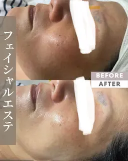フェイシャルエステ