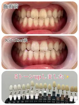 セルフホワイトニング　8分×2set