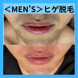 【メンズ脱毛大人気No1】ヒゲ脱毛