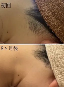 【モニター限定】ビフォーアフター撮影にご協力いただける方限定価格★うなじ脱毛折り返し連絡後確定キャッシュレス決済のみ