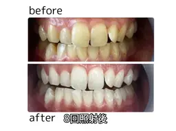 黄ばみを一気に解消！8分×8回照射