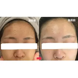 U25限定! 学割プラン(エステ3回分+ハイドロパック2回分付き✨)