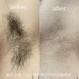 一期一会に感謝💓お得に全身ツルツル！