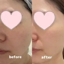 【くすみ・シミ・肌のごわつきでお悩みの方へ】ピーリングで透明感のある肌へ