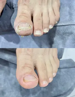 フットケア
