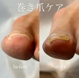 フット《巻き爪ケア》1本の価格