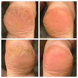 フットの角質ケア