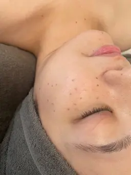 【もう悩まない】シミを垢にして排出する🔥シミ特別ケアコース