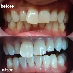 【ミニモ学割】１５歳以上の学生セルフホワイトニング８分照射×２回