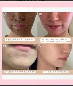 ハーブピーリング【剥離あり】+鎮静パック💐肌を根本から改善させる✨️ニキビ肌、キメに効果あり!