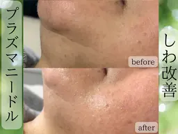 先着10名様!(毛穴/ニキビ/黒ずみ◎)次世代最新美容◎プラズマニードルカリファEX+スッキリ毛穴洗浄⭐︎