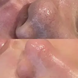 鼻のみ毛穴洗浄