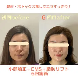 劇的小顔リフト（小顔矯正+ems+超音波）💆‍♀️丸顔/エラ/二重顎/フェイシャルマッサージ/小顔マッサージ/コルギ