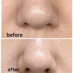 黒ずみ毛穴洗浄×全顔導入付き【角栓詰まり◎黒ずみ◎ざらつき◎】角栓ポップアップ洗浄！！角栓浮き上がり◎つるん肌へ