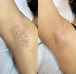 脇wax脱毛