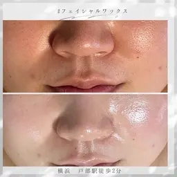 【ミニモ限定割引】お顔ワックス＋スキンチャージケア