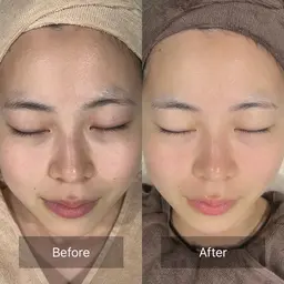 【人気No.1✨️】1ヶ月集中モニター🤍4回のエステ付き