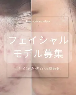 【モデル募集】ニキビ×赤みケア40分🫧長年の悩みに。(クレンジング→悩み別クリスティーナピーリング→マスク→仕上げ)