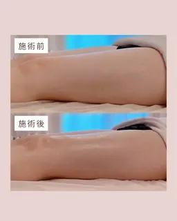 肩こりやむくみにお悩みの方へ✨インディバボディ90分✨