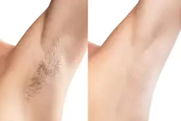 《両脇脱毛¥330》事前シェービング不要🎀✨