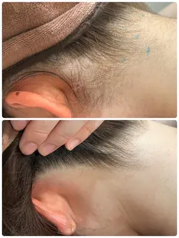 🍂秋こそ美しさを手に🍂うなじ脱毛、ポニーテールや背中美人へ！是非1度お任せ下さい✨