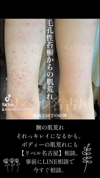 腕の毛孔性苔癬を剥離ハーブピーリングで改善