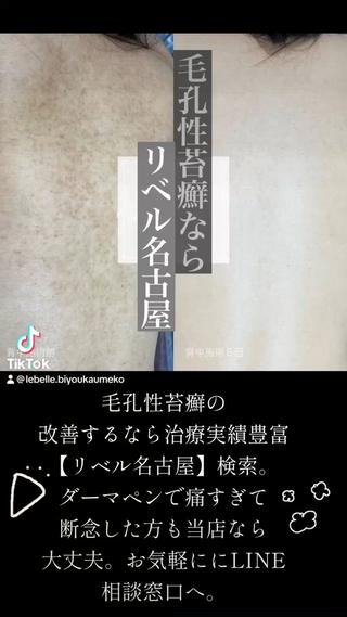 背中の毛孔性苔癬を剥離ハーブピーリングで改善
